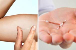 HPM agora oferece métodos contraceptivos, como (DIU) e o Implanon. (Foto: Reprodução Internet)