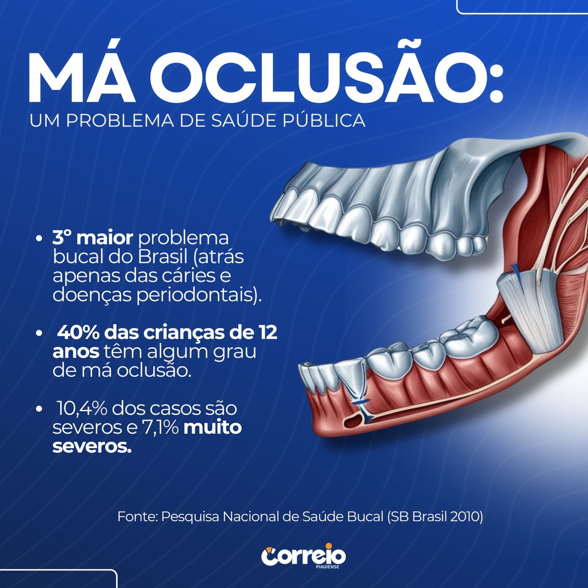 Dados da Pesquisa Nacional de Saúde Bucal – SB Brasil 2010.