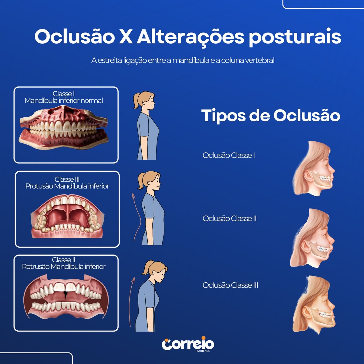Oclusão e alterações posturais.