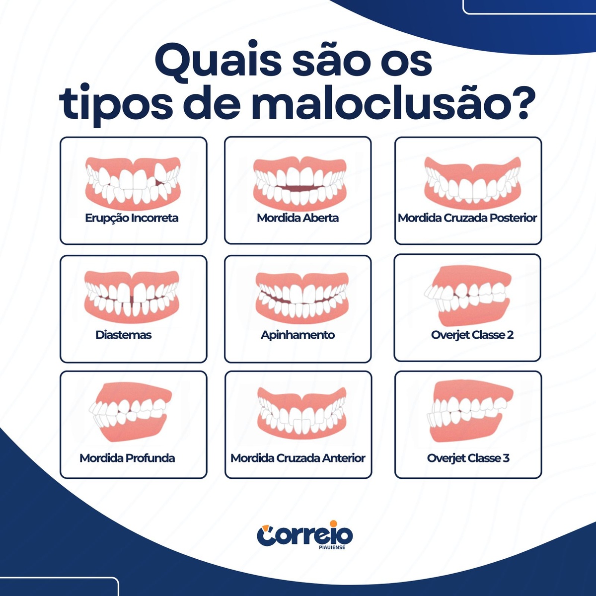 Tipos de mal oclusão.