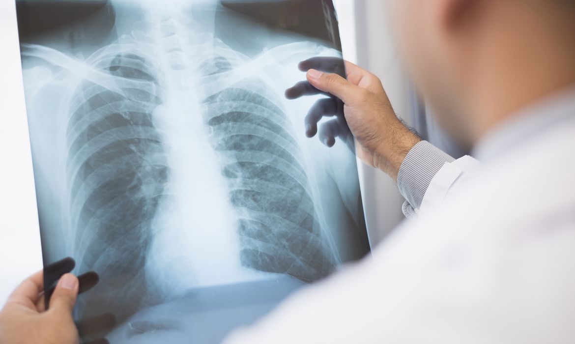 Anvisa aprova novo medicamento para câncer de pulmão.